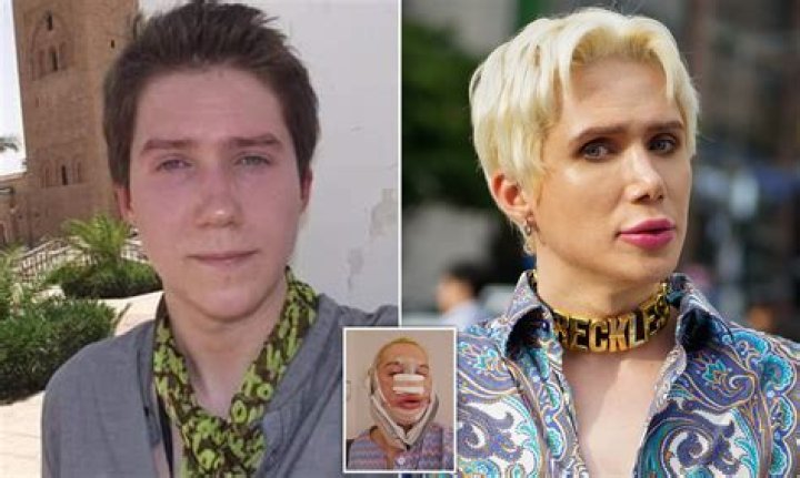 Oli London Before Surgery And Operation